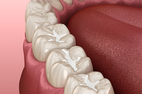 composite-fillings-dental-zen