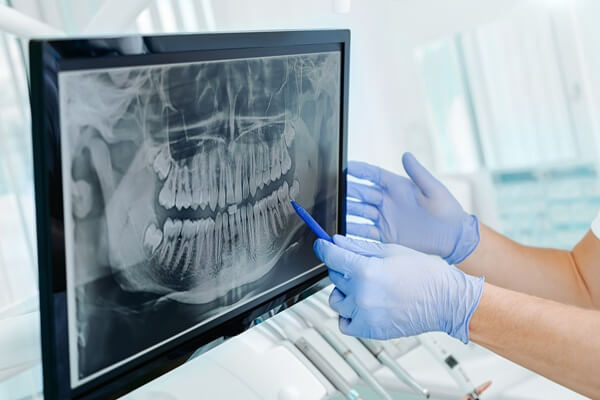 panoramic-x-rays-dental-zen