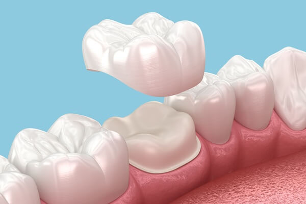porcelain-crowns-caps-dental-zen