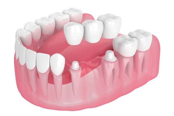 porcelain-fixed-bridges-dental-zen